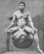 elefantiasis.jpg