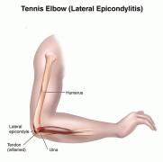TENNIS ELBOW⠀ANATOMY, PATHOLOGY AND SELF-TREATMENT⠀Tennis elbow is a problem with the tendons that attach the bony bump at the outer side of your elbow with the muscles in your forearm and wrist.⠀Tendons can be injured suddenly or t.jpg