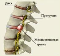 Межпозвонковая грыжа и протрузия диска.jpg