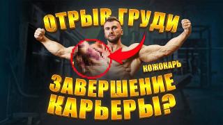 Андрей Кожокарь - отрыв грудной мышцы.jpg