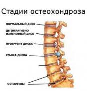 грыжа.jpg