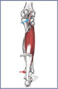 Plantaris-with-the-tendon-conjoined-with-the-Achilles_002.jpg