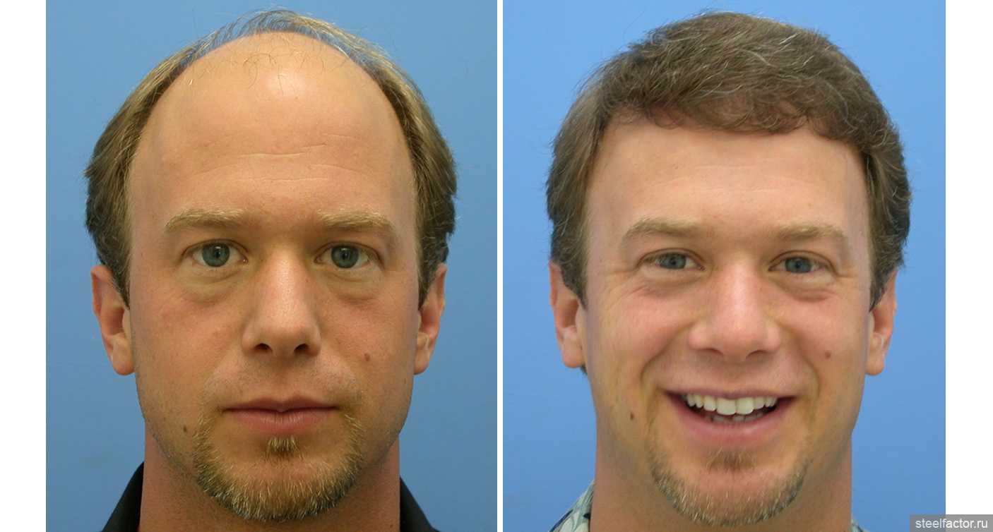 Мужчина после 75. Трансплантация волос до и после. До и после пересадки волос мужчинам. Пересадка волос фото до и после. Трансплантация волос у мужчин до и после.
