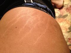 stretch_marks_on_legs_1.jpg